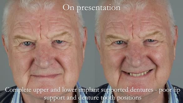 Newsletter 57 showcases the making and fitting process of implant-supported complete dentures for Alisdair