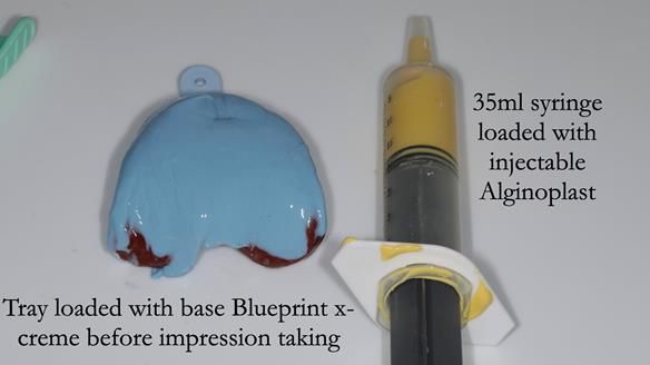 Newsletter 56 showing the making and fitting of a bilateral free end saddle upper removable partial denture (RPD) for patient with pemphigus
