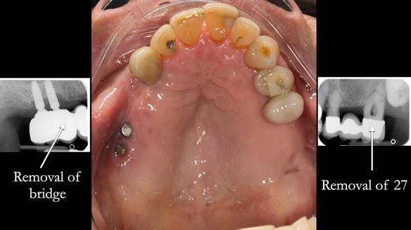 Ken – going downhill, first class