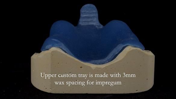 Newsletter 57 showcases the making and fitting process of implant-supported complete dentures for Alisdair
