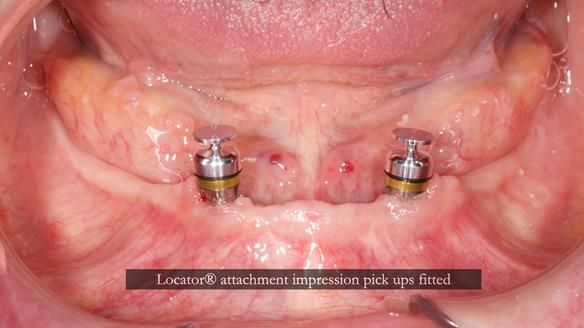 Newsletter 78: What do Clark Gable and a Locator® overdenture have in common?