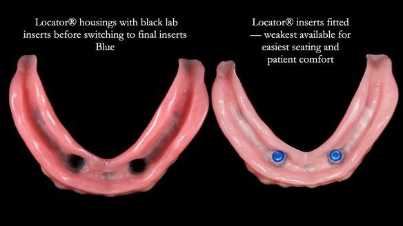 Newsletter 78: What do Clark Gable and a Locator® overdenture have in common?