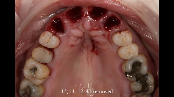 Finlay's Newsletter 63 Case study provision of metal based Scandinavian RPD - functional 10 years on
