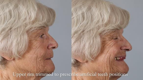 Eileen's transformation with upper and lower RPDs of Scandinavian hygienic design FULL PROTOCOL