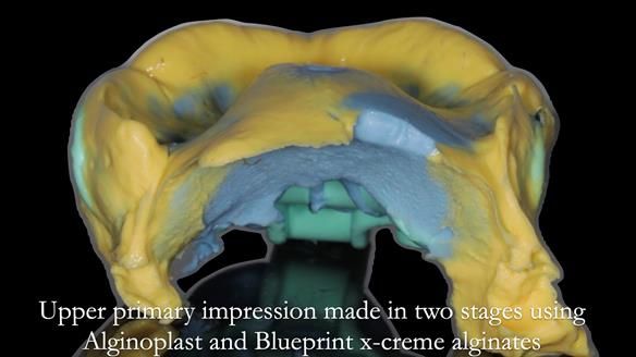 Finlay's Newsletter 58 Gasket upper partial denture for Zoe