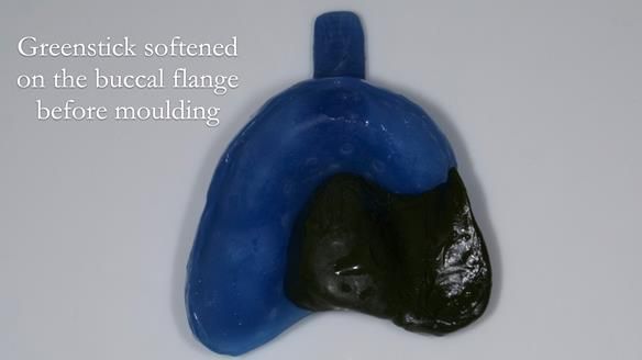 Finlay's Newsletter 64 case study - provision of a Kennedy class 2 metal based Scandinavian RPD for Ian