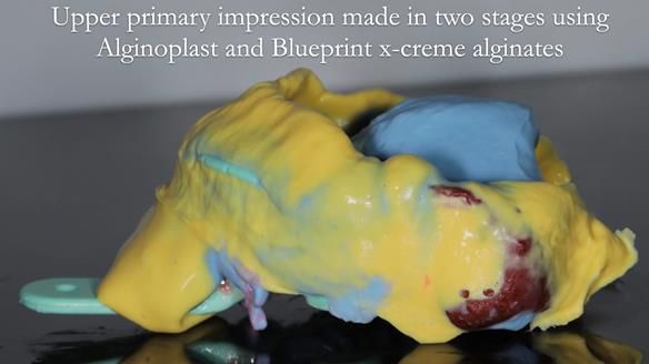 Finlay's Newsletter 60 Sylvia's upper Kennedy Class 2 Mod 1 metal based upper RPD