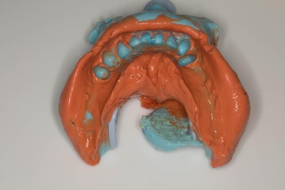 Figure 7 Visit 1. Mandibular primary impression made in two stages using Accudent XD, Ivoclar. This allows full extension to record the sulcus. This was used to produce a primary cast on which the immediate denture was constructed. The teeth were too mobi