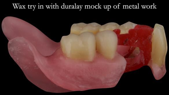 Finlay's Case Study Newsletter 40 - Immediate Mk 1 RPD to Definitive Mk 2 RPD - full protocol