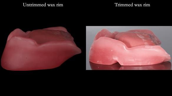 Newsletter 82 Mary - A complete upper and a one-tooth gasket denture
