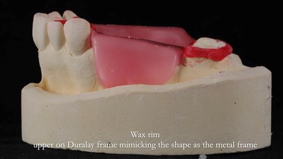 Finlay's Newsletter 60 Sylvia's upper Kennedy Class 2 Mod 1 metal based upper RPD