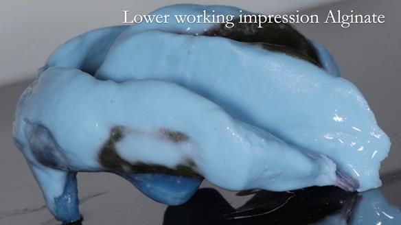 Newsletter 53 showing the making and fitting of ultra life-like dentures for Valena