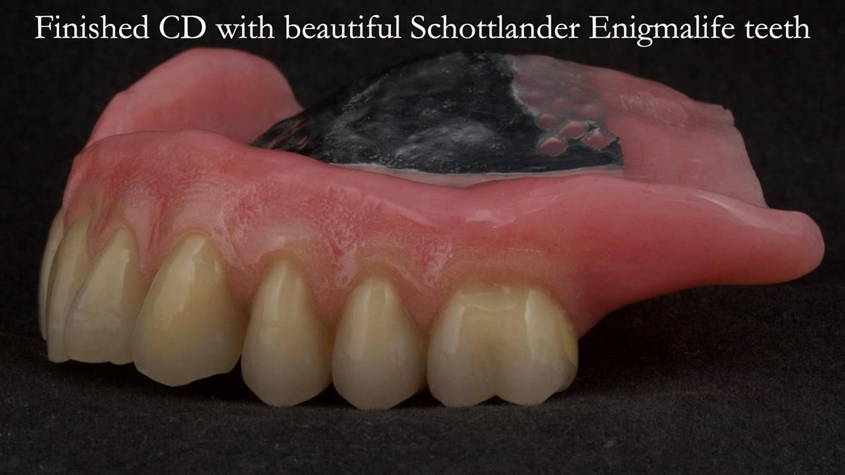 Newsletter 87 – Father Peter: A Partial Denture that needed Minor Miracle