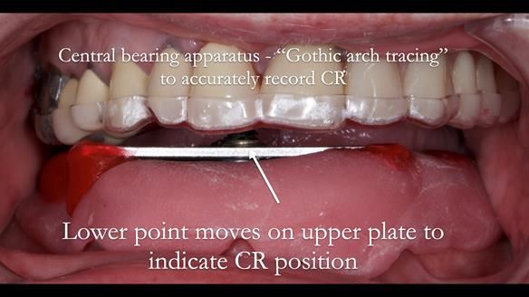 Newsletter 44 - extreme removable prosthodontics – engineering a super-strong and ultra-thin over denture