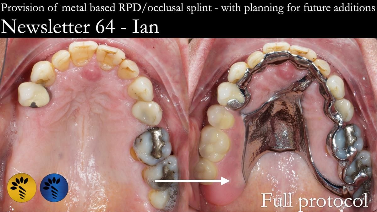 Finlay's Newsletter 64 case study - provision of a Kennedy class 2 metal based Scandinavian RPD for Ian