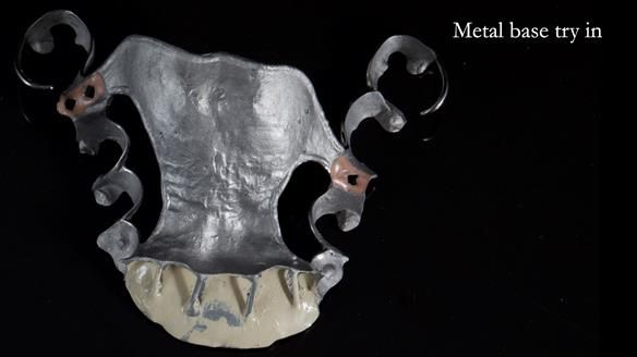 Newsletter 81 - Pam’s Story — how a partial denture changed her life (+ live walkthrough this Thursday)