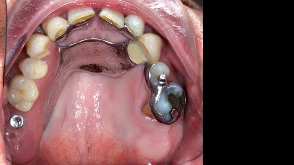 Newsletter 86 Peter the Architect — precision removable partial dentures case study