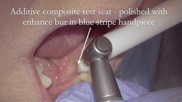 Finlay's Case Study Newsletter 40 - Immediate Mk 1 RPD to Definitive Mk 2 RPD - full protocol
