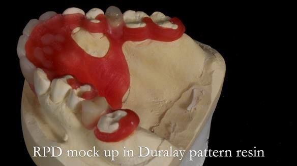 Newsletter 81 - Pam’s Story — how a partial denture changed her life (+ live walkthrough this Thursday)