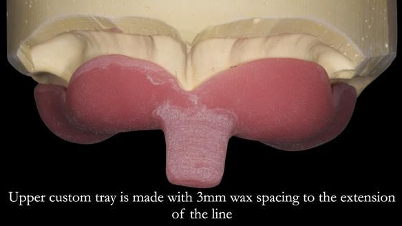 Newsletter 50 Special edition Complete Dentures FULL PROTOCOL