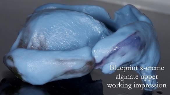 Newsletter 77: Jeremy’s case – immediate complete upper denture