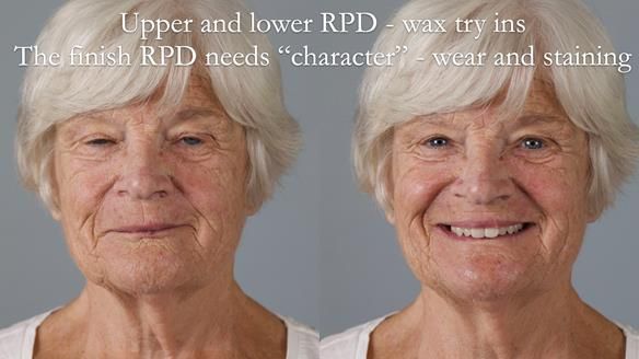 Eileen's transformation with upper and lower RPDs of Scandinavian hygienic design FULL PROTOCOL