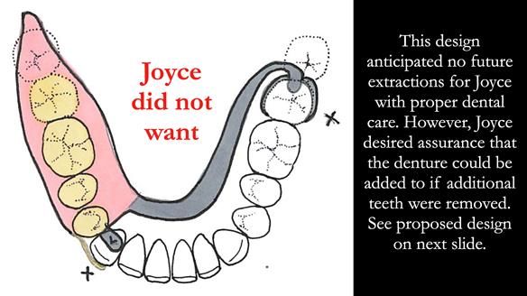 Finlay's Newsletter 61 provision of a lower unilateral free end saddle metal based partial denture for Joyce
