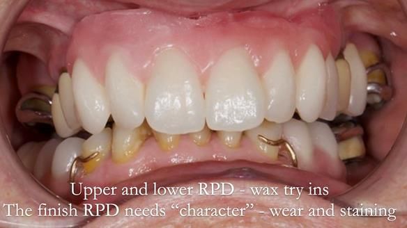 Eileen's transformation with upper and lower RPDs of Scandinavian hygienic design FULL PROTOCOL