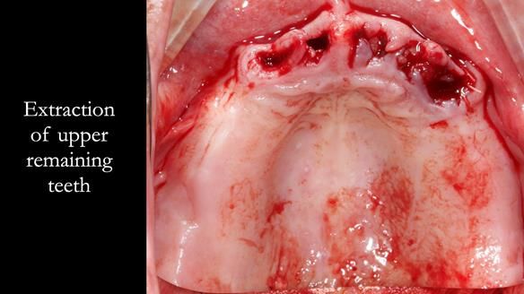 Finlay's Newsletter 62 provision of extractions and metal based complete dentures for Rafique