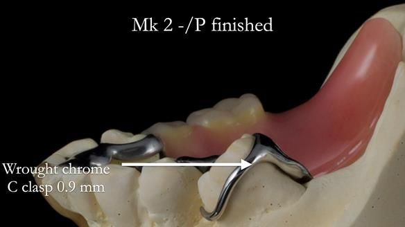 Newsletter 54 case presentation upper complete denture and lower Scandinavian designed hygienic partial denture for David