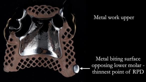 Finlay's Newsletter 59 Ultra hard partial dentures made for Gill