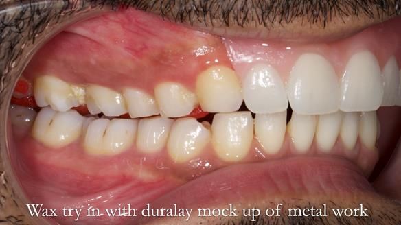 Upper metal base partial denture/occlusal stabilisation splint/obturator - full protocol