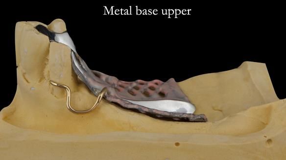 Finlay's Case Study Newsletter 40 - Immediate Mk 1 RPD to Definitive Mk 2 RPD - full protocol