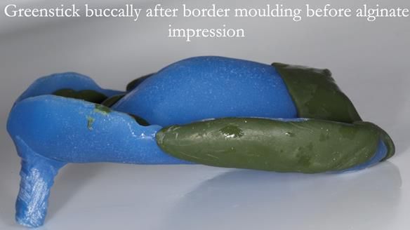 Newsletter 53 showing the making and fitting of ultra life-like dentures for Valena