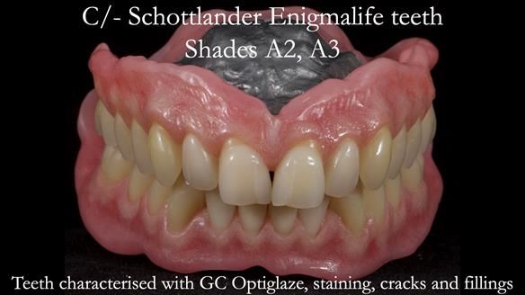 Newsletter 57 showcases the making and fitting process of implant-supported complete dentures for Alisdair