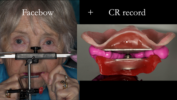 Figure 88 Facebow and CR record (central bearing apparatus) are using to mount the definitive casts on the articulator