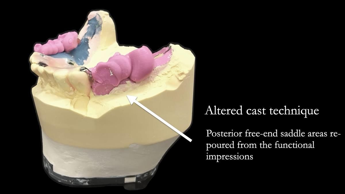Newsletter 87 – Father Peter: A Partial Denture that needed Minor Miracle