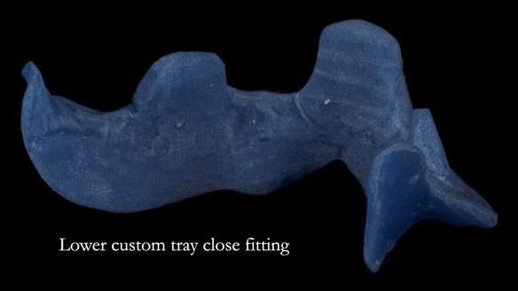 Newsletter 83: Sheila’s Complete Denture Success