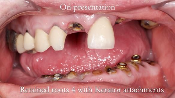 Newsletter 44 - extreme removable prosthodontics – engineering a super-strong and ultra-thin over denture