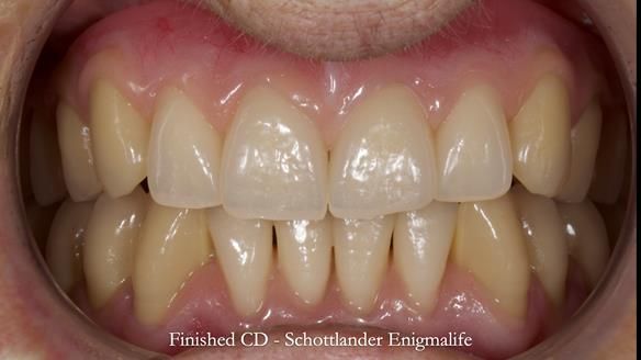 Newsletter 83: Sheila’s Complete Denture Success