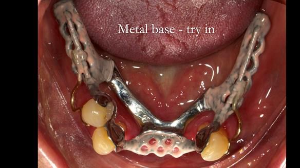 Finlay's Case Study Newsletter 40 - Immediate Mk 1 RPD to Definitive Mk 2 RPD - full protocol