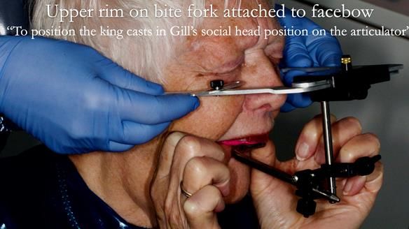 Finlay's Newsletter 59 Ultra hard partial dentures made for Gill