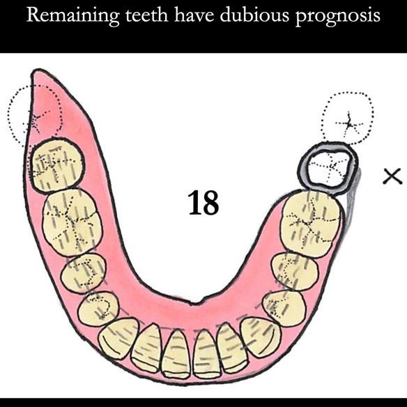 Universal Scandinavian partial denture designs