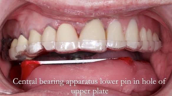 Newsletter 44 - extreme removable prosthodontics – engineering a super-strong and ultra-thin over denture
