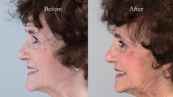 Newsletter 75: Marion’s case - Step-by-step complete denture workflow
