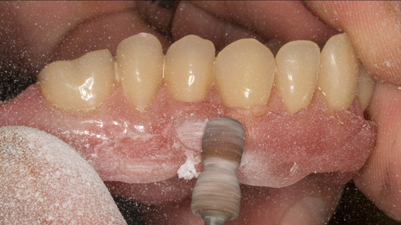 Figure 47 Trimming the periphery of the reline
