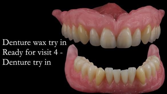 Newsletter 50 Special edition Complete Dentures FULL PROTOCOL