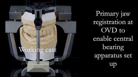 Newsletter 44 - extreme removable prosthodontics – engineering a super-strong and ultra-thin over denture
