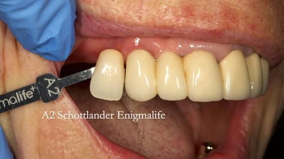 Newsletter 76: Jackie’s case – Telescopic overdenture & precision RPD (the tricky truth!)
