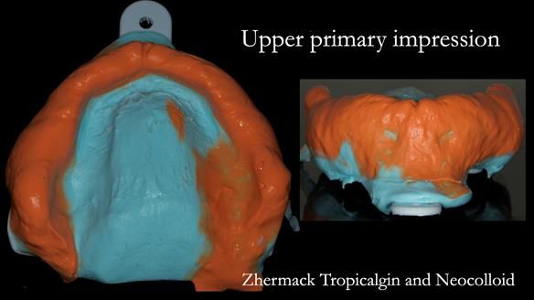 Syringe light bodied alginate into the sulcus from hamular notch round to hamular notch. The heavy bodied alginate is carried in a Schottlander Edentulous tray.